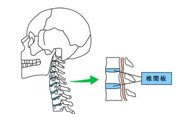 頚の椎間板の図